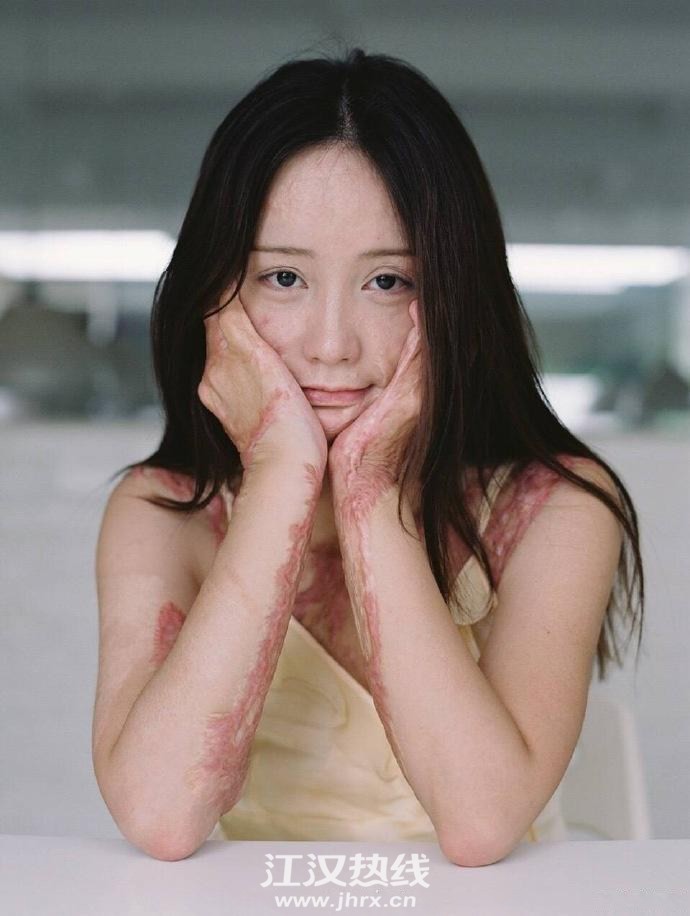 花季少女5年前遭同学泼油点火,落下一身疤痕,如今勇敢拍个人写真!